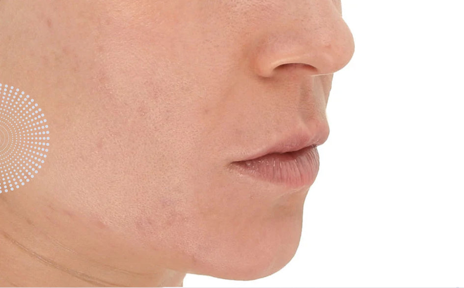 LightStim for Acne