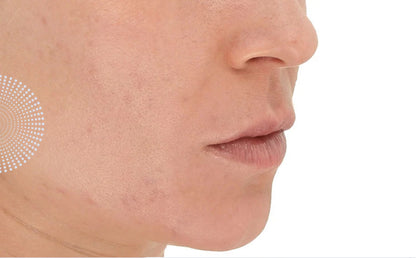 LightStim for Acne