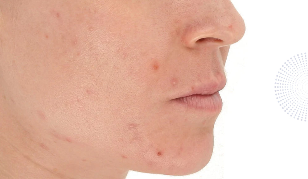LightStim for Acne