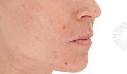 LightStim for Acne